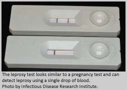 The leprosy test looks similar to a pregnancy test and can detect leprosy using a single drop of blood.