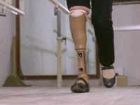 Low cost, quality prosthetic
